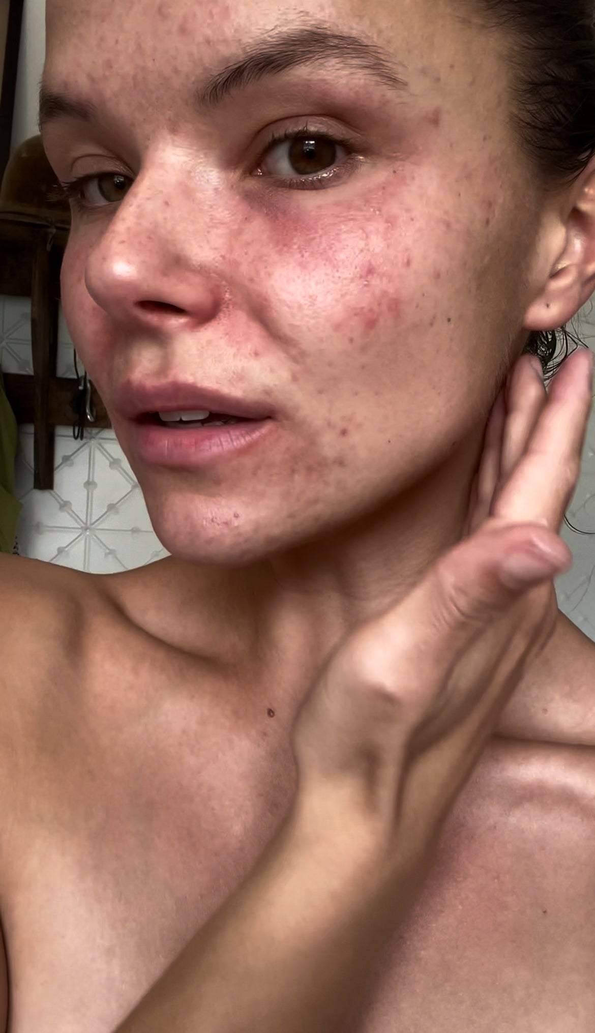 Sensitive Skin 101: Best Skincare Routines for Common Irritations