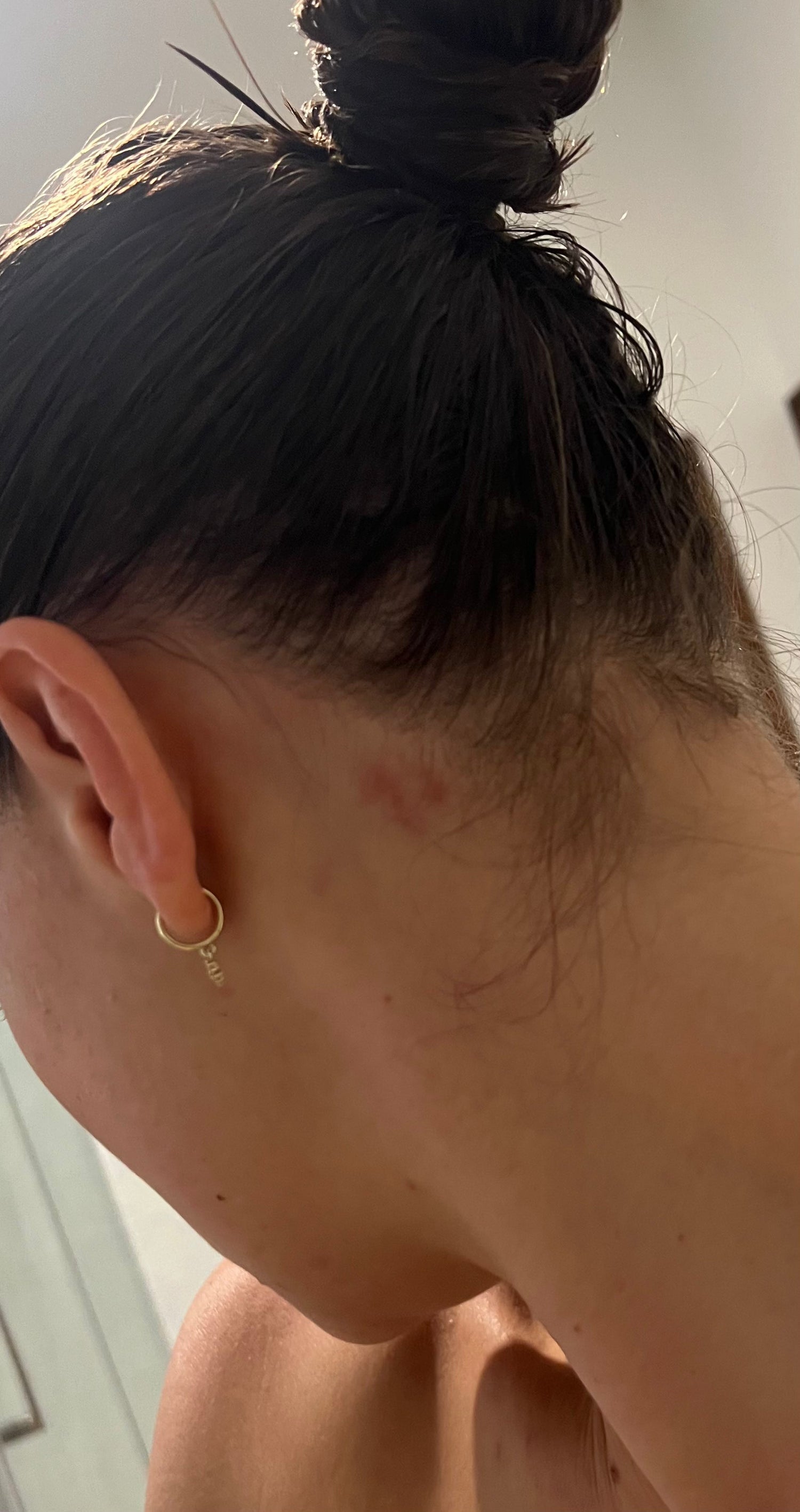 Eczema vs. Psoriasis: Key Differences You Should Know