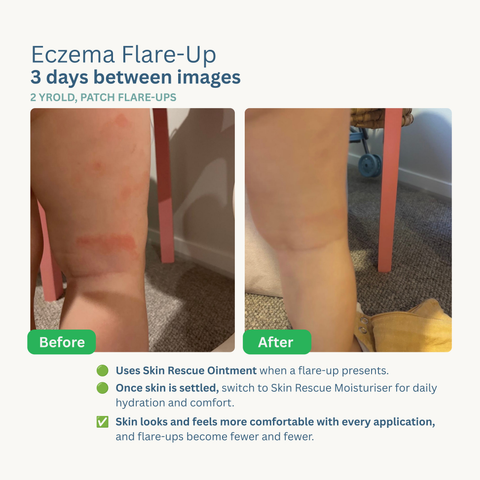Skin Rescue Ointment  & Moisturiser Bundle