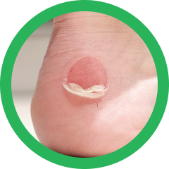 Burns & Blisters