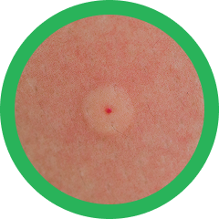 Bug Bites & Stings